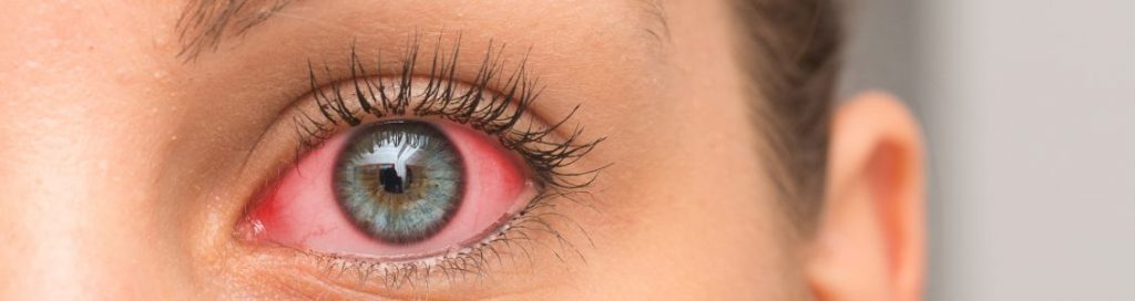 EFFECTIVE HOME REMEDIES FOR TREATING CONJUNCTIVITIS