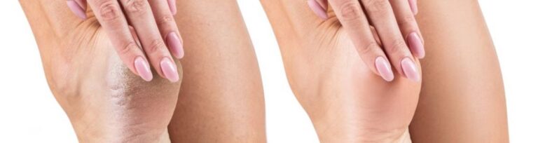 Ayush for cracked heels