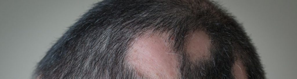 Managing alopecia areata through Ayurveda