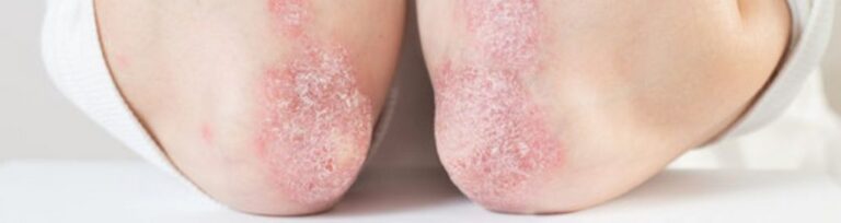 Ayush Ayurveda psoriasis management