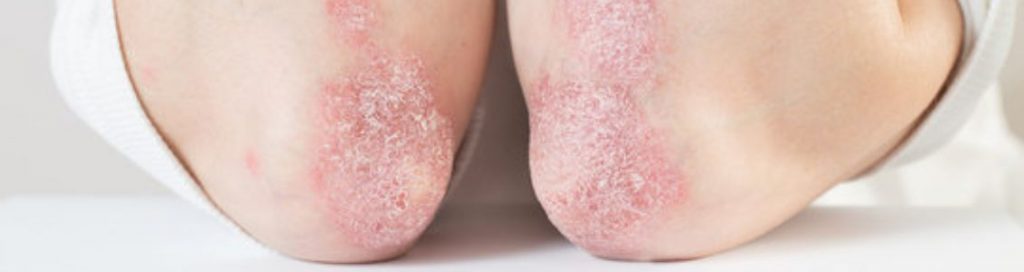 Ayurvedic Singapore’s approach to psoriasis management