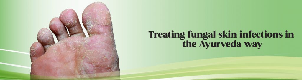Treating fungal skin infections in the Ayurveda way